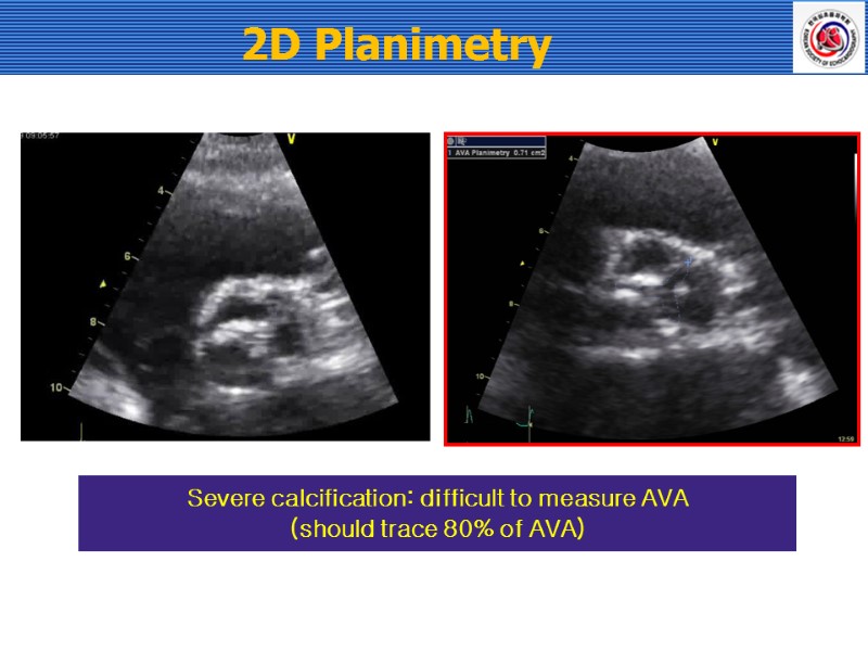2D Planimetry   Severe calcification: difficult to measure AVA (should trace 80% of